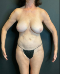 Liposuctions with Renuvion Case 1 After